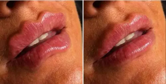 Tren Filler Bibir Keriting Viral di Media Sosial, Aneh atau Unik?