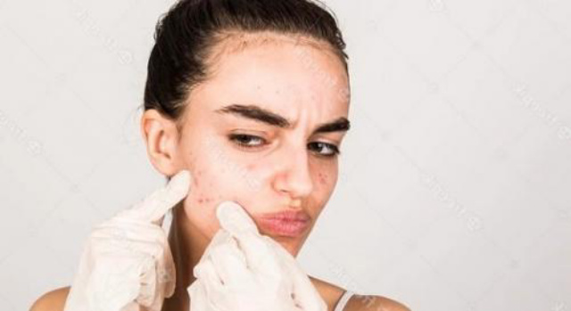 Viral Obat Merah untuk Atasi Jerawat, Apakah Aman?