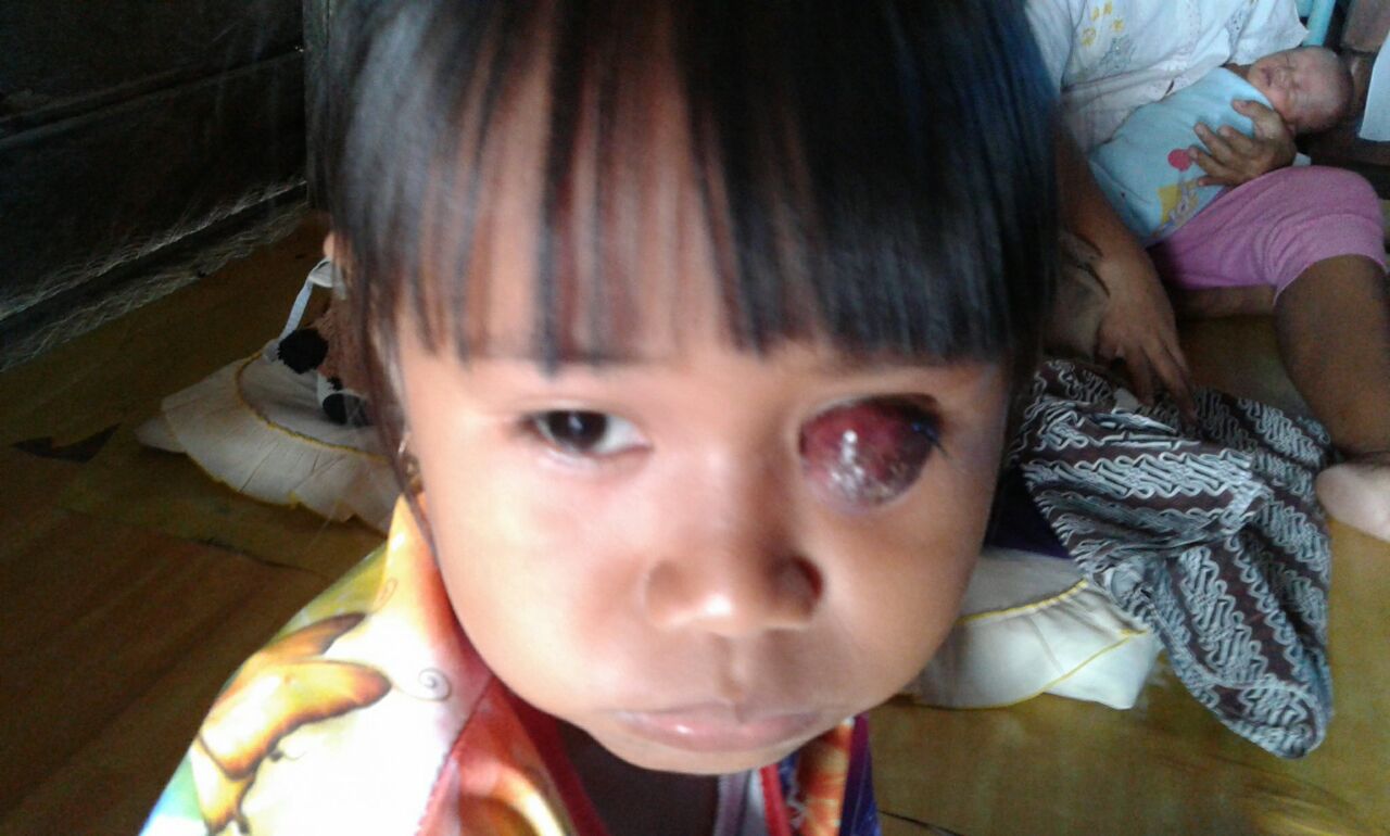 Elis, Si Penderita Gejala Kanker Mata Asal Inhil Butuh Uluran Tangan
