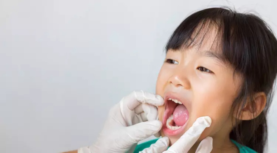 Ini Loh Dampak Polio pada Kesehatan Gigi dan Mulut