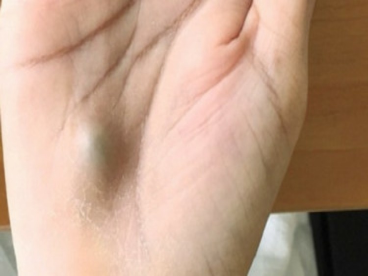 Benjolan Mematikan Muncul Di Tangan Usai Ke Dokter Gigi, Apa Itu?