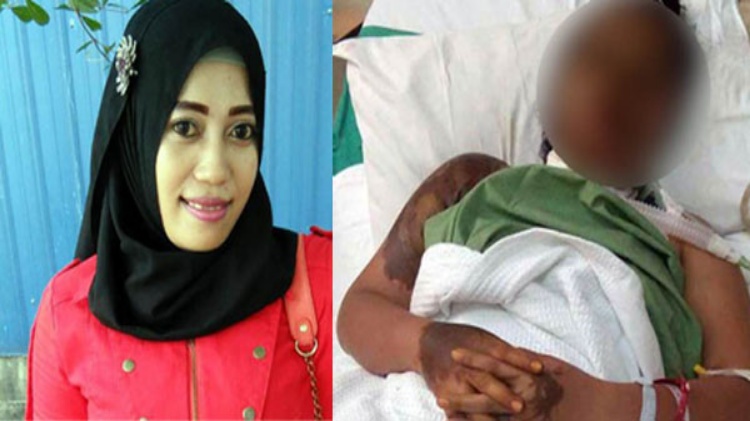 Miris...!!! Jadi TKW di Malaysia, Wanita Ini Disiram Air Keras oleh Mantan Pacarnya