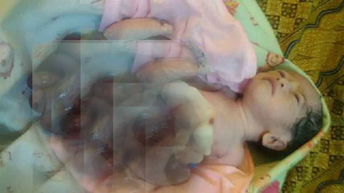 Bayi Lahir dengan Usus dan Lambung Terburai di Bengkalis Meninggal Dunia